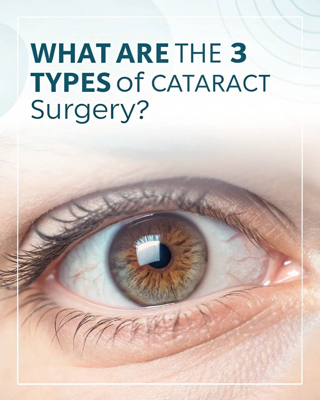 What Are the 3 Types of Cataract Surgery?