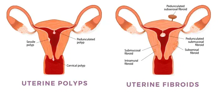 Uterine Fibroids & Polyps Treatment India 2026