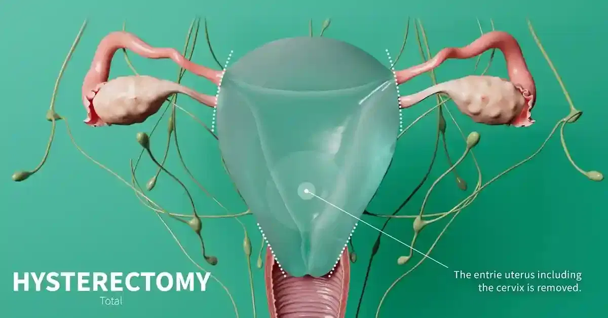 hysterectomy