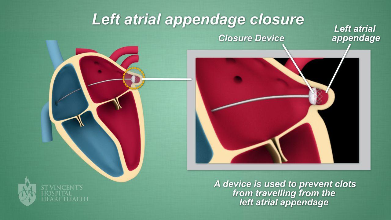 Left Atrial Appendage Closure (LAAC)