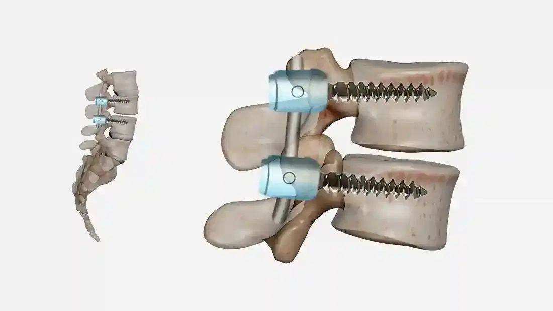 spinal fusion surgery