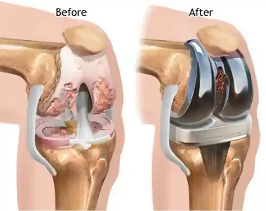 Total Knee Replacement (TKR) Total Knee Replacement (TKR)