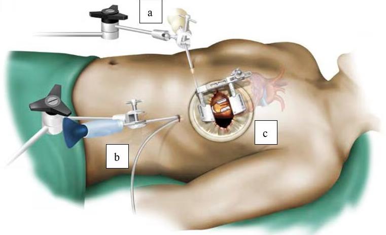 Minimally Invasive Coronary Artery Bypass Surgery (MICS CABG)