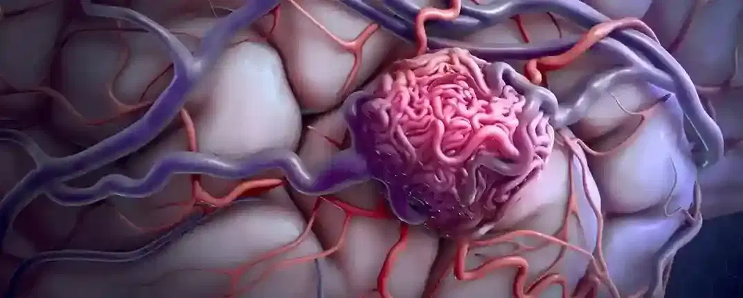 avm brain surgery