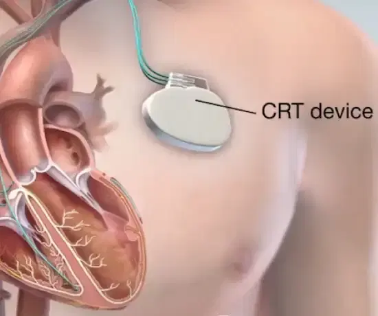 Cardiac Resynchronisation Therapy (CRT)