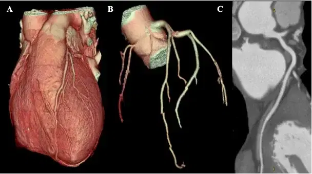 CT Coronary Angiography