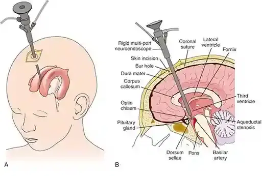 endoscopic third ventriculostomy