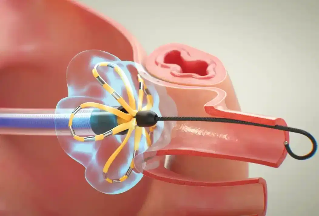 atrial fibrillation ablation
