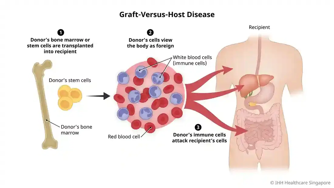 GVHD Treatment
