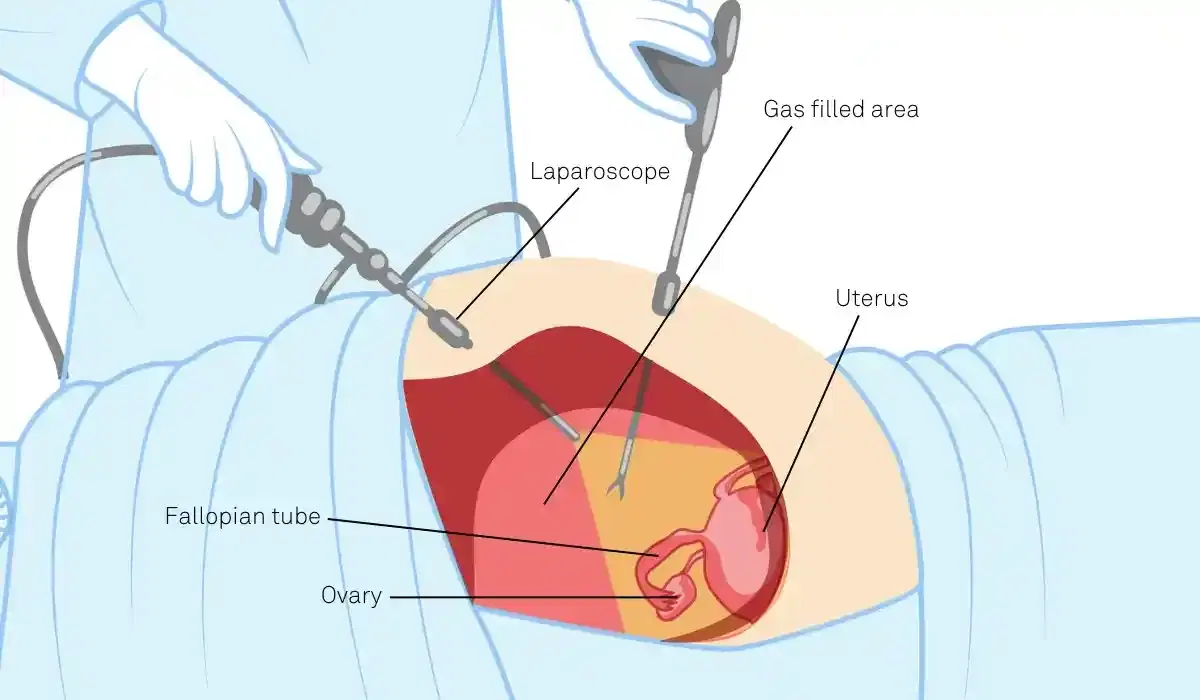 reproductive surgery