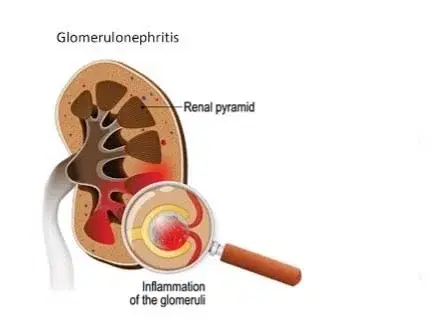 Glomerulonephritis Management