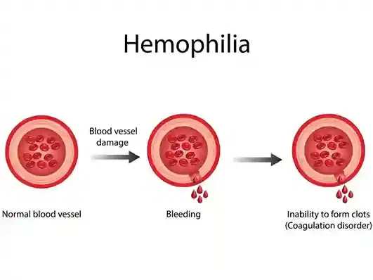 Hemophilia Care Program