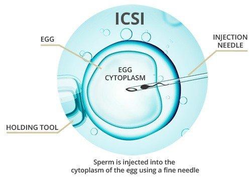 Intracytoplasmic Sperm Injection (ICSI)