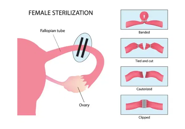 Tubal Ligation Reversal (Reversal of Sterilization)