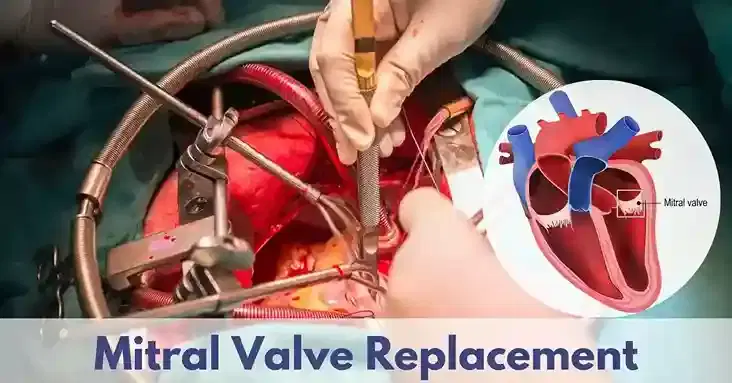 mitral valve surgery