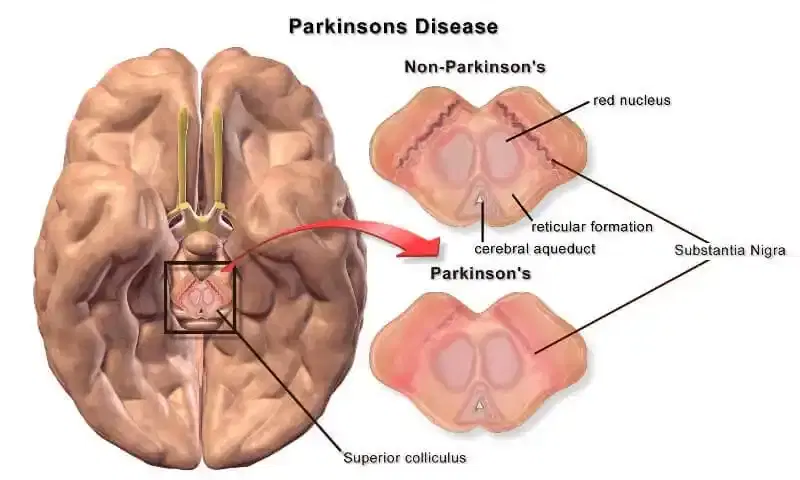 parkinson disease treatment
