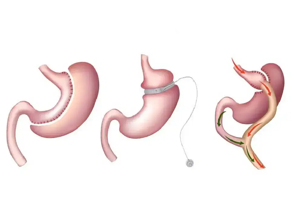 Revision Bariatric Surgery