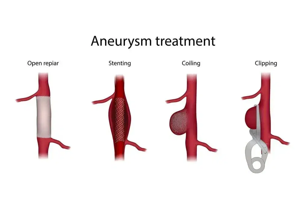 Brain Aneurysm Treatment (Clipping / Coiling)