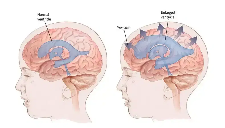 vp shunt surgery