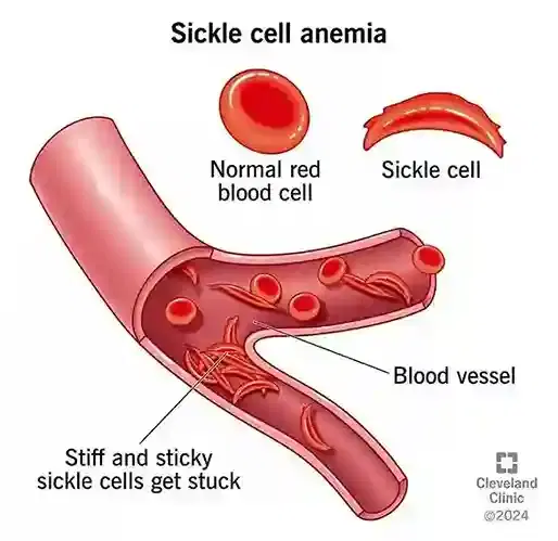 Sickle Cell Disease Management