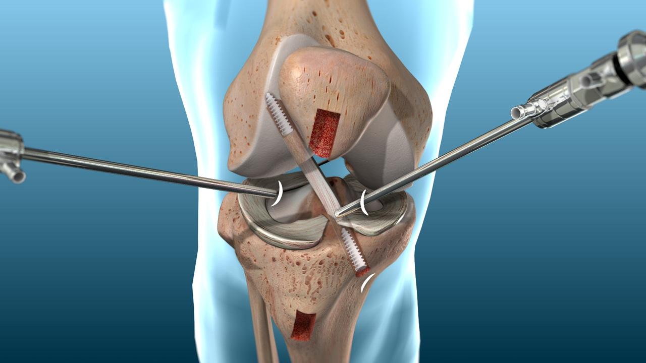 Arthroscopic ACL Reconstruction