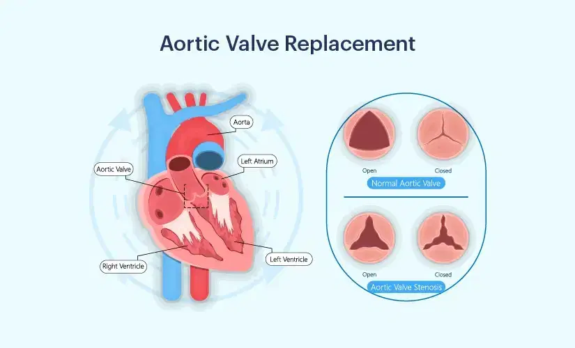 Aortic Valve Repair / Replacement