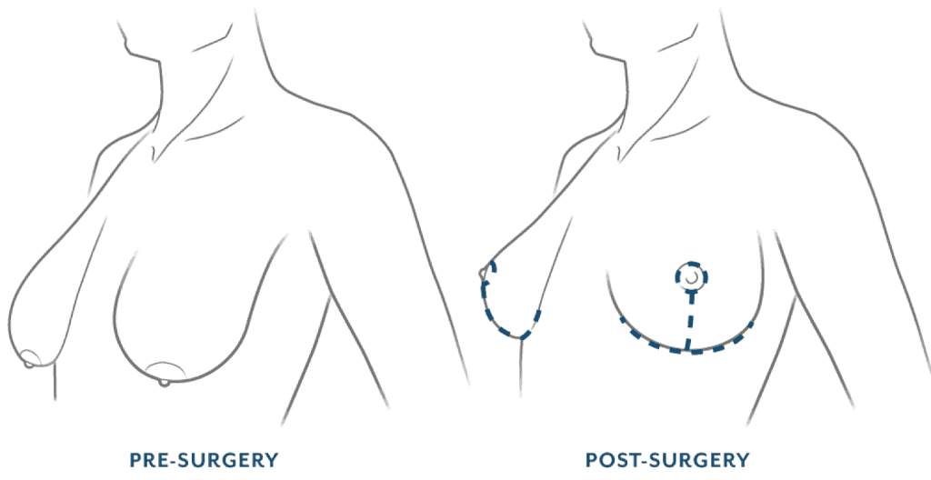 Breast Augmentation/Reduction