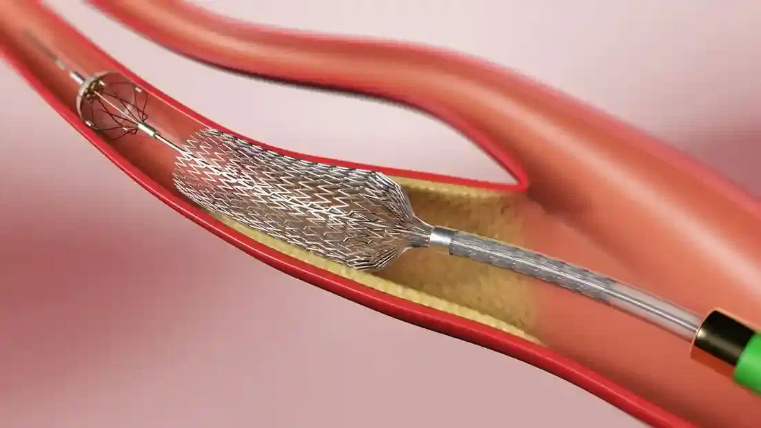 carotid angioplasty
