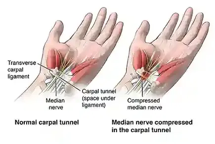 Peripheral Nerve Surgery (Carpal Tunnel / Ulnar Nerve)