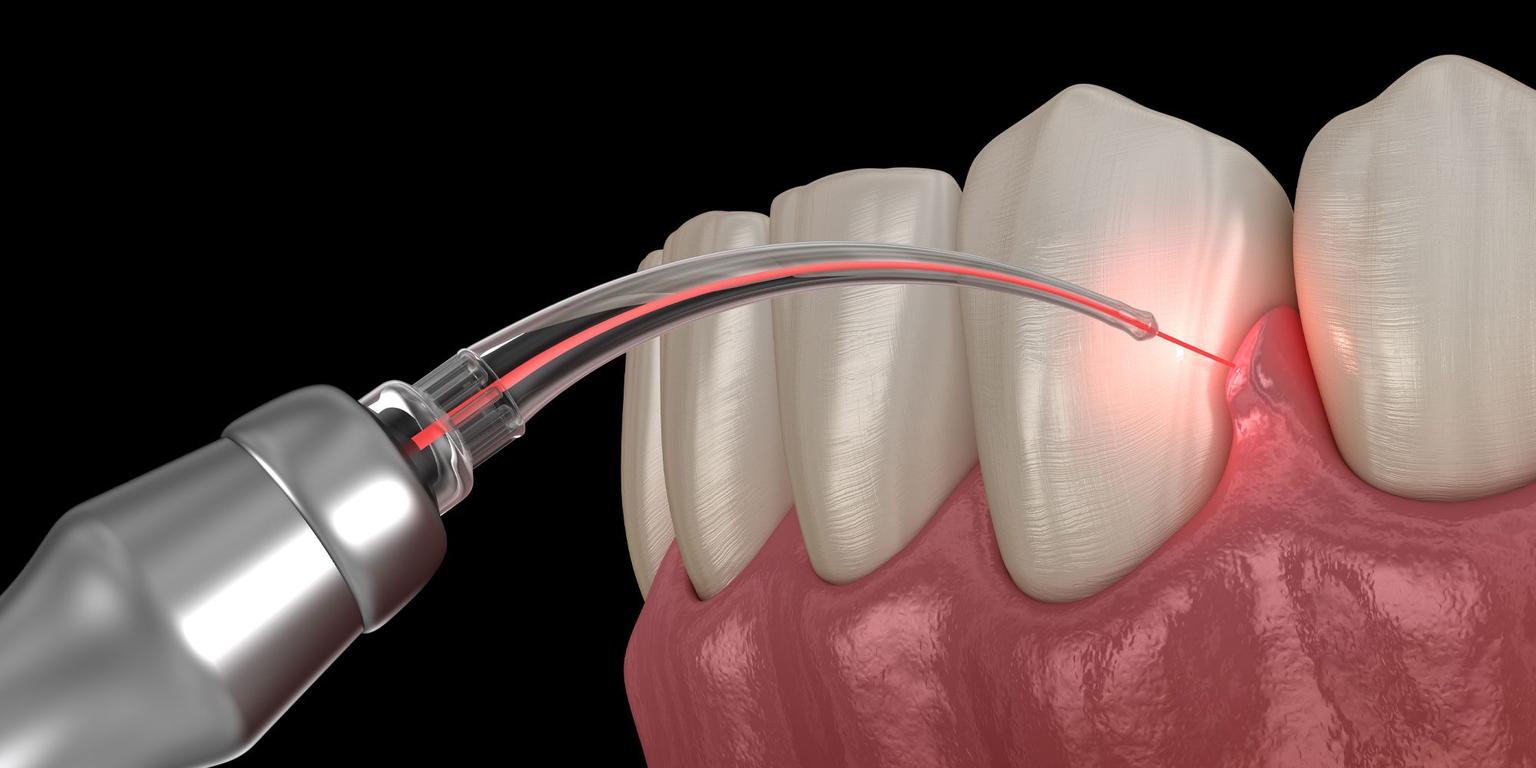 Laser Gum Surgery