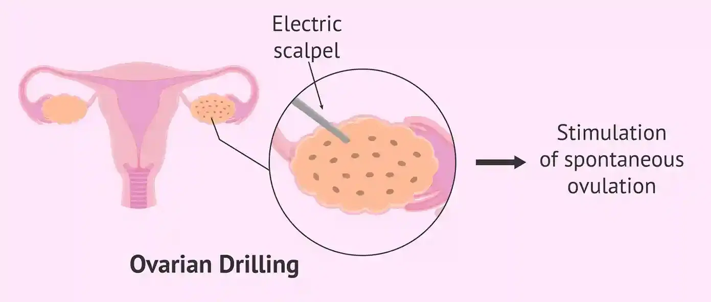 ovarian drilling