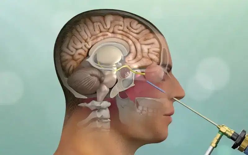 endoscopic brain surgery