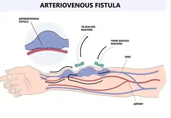 AV Fistula Creation for Dialysis