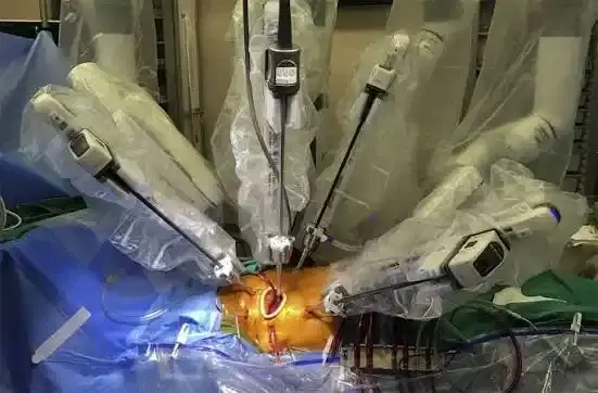robotic cardiac surgery