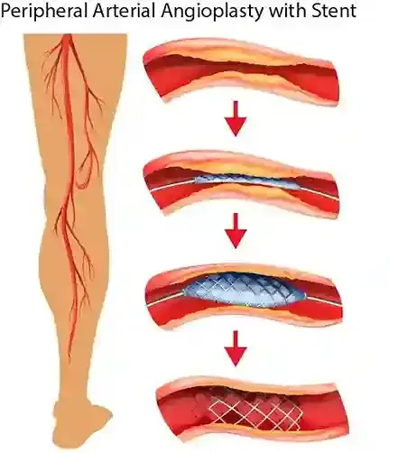 Peripheral Angioplasty / Stenting (Leg)