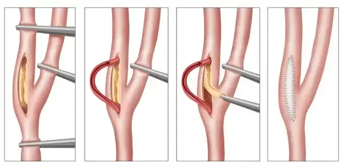 Carotid Endarterectomy