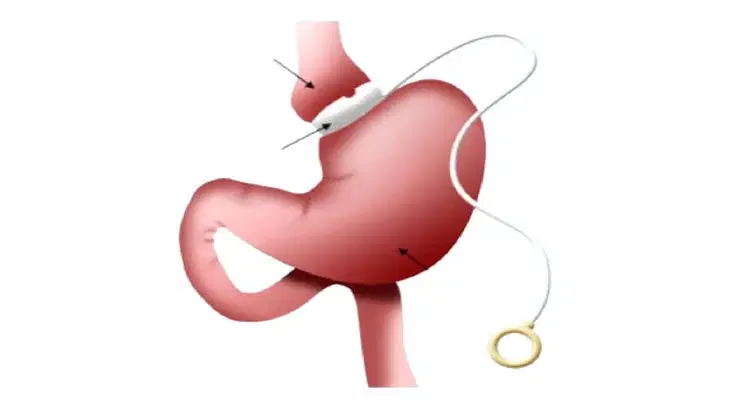 Adjustable Gastric Banding