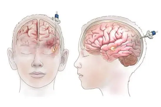 epilepsy surgery