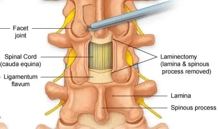 laminectomy surgery