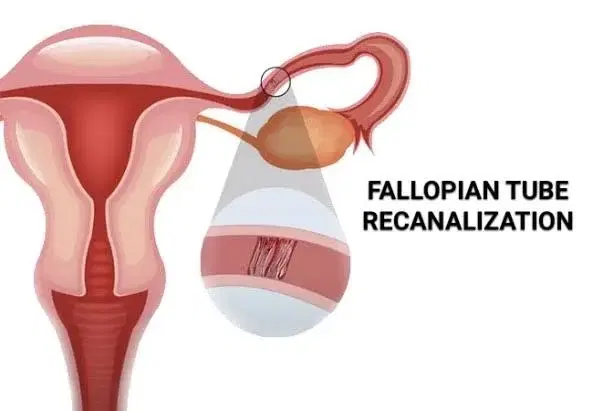 tubal recanalization