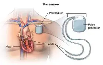 Pacemaker Implantation