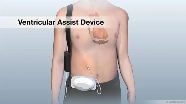 Ventricular Assist Device (VAD)