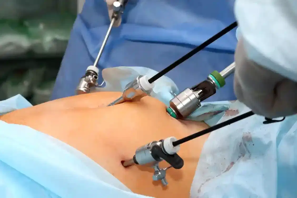 laparoscopic hysterectomy
