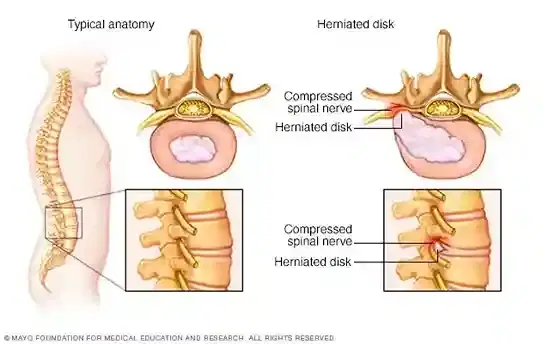 Disc Herniation Surgery (Discectomy)