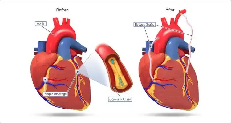 Minimally Invasive CABG / MIDCAB