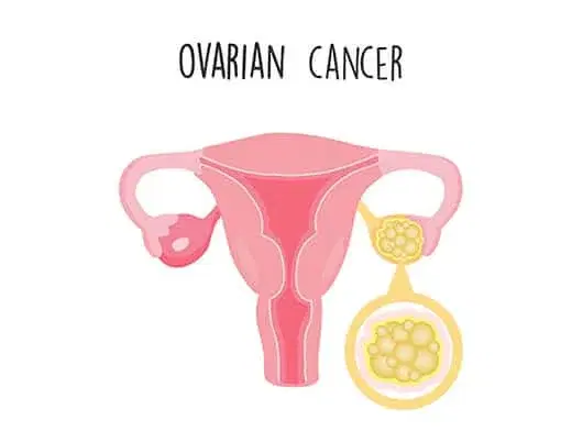ovarian cancer surgery