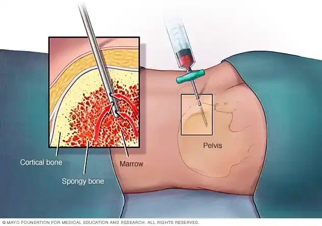 leukemia treatment
