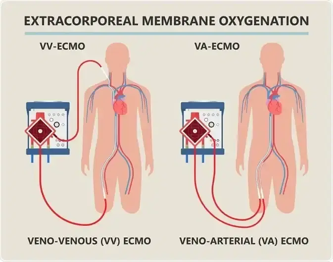 ECMO Support (as service capability)
