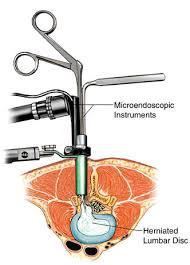 Minimally Invasive Spine Surgery