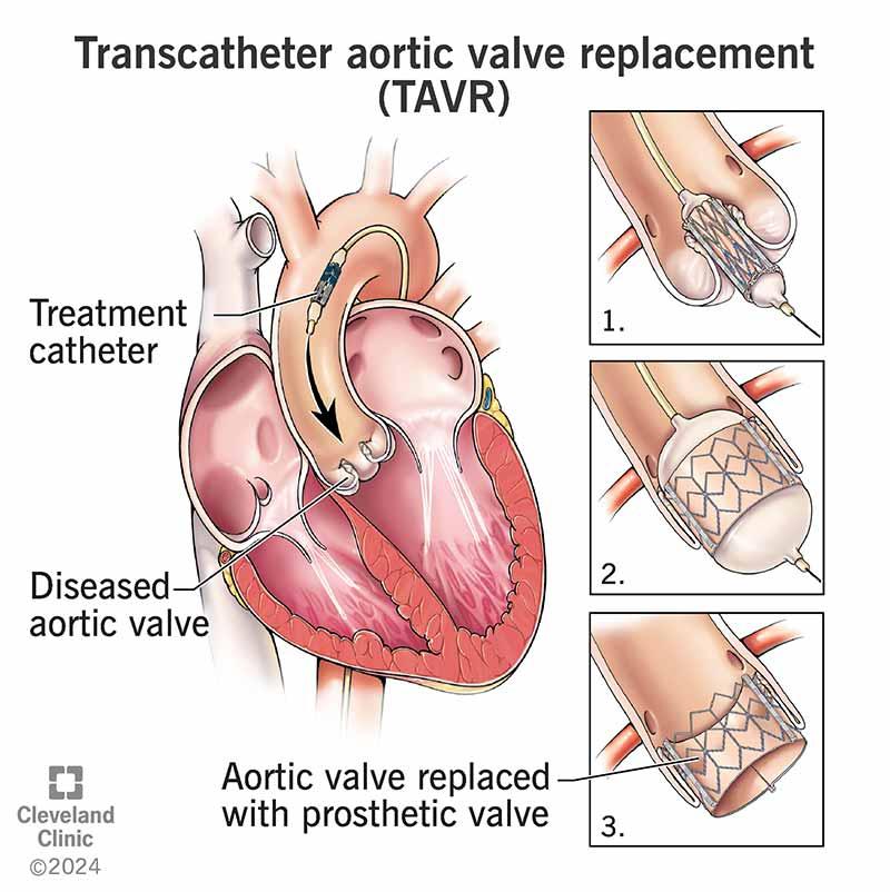 TAVR (Transcatheter Aortic Valve Replacement)